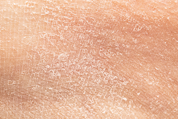 Chimiothérapie et xérose : mieux vaut prévenir